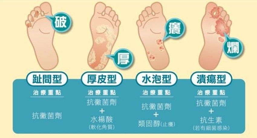 足癬類型
