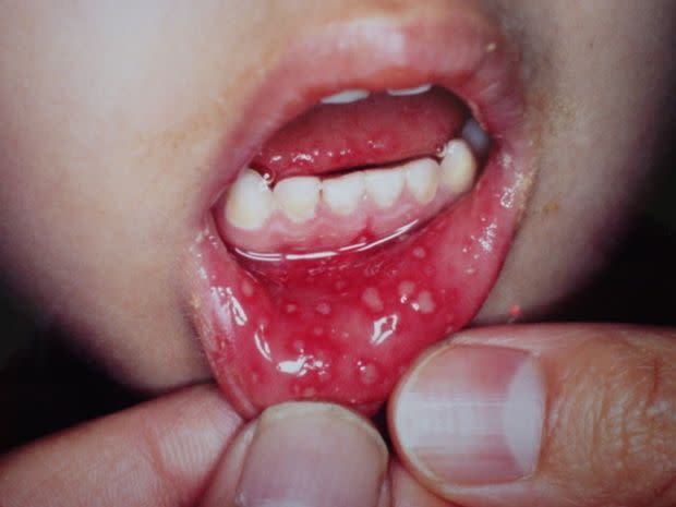 手足口病口腔症狀