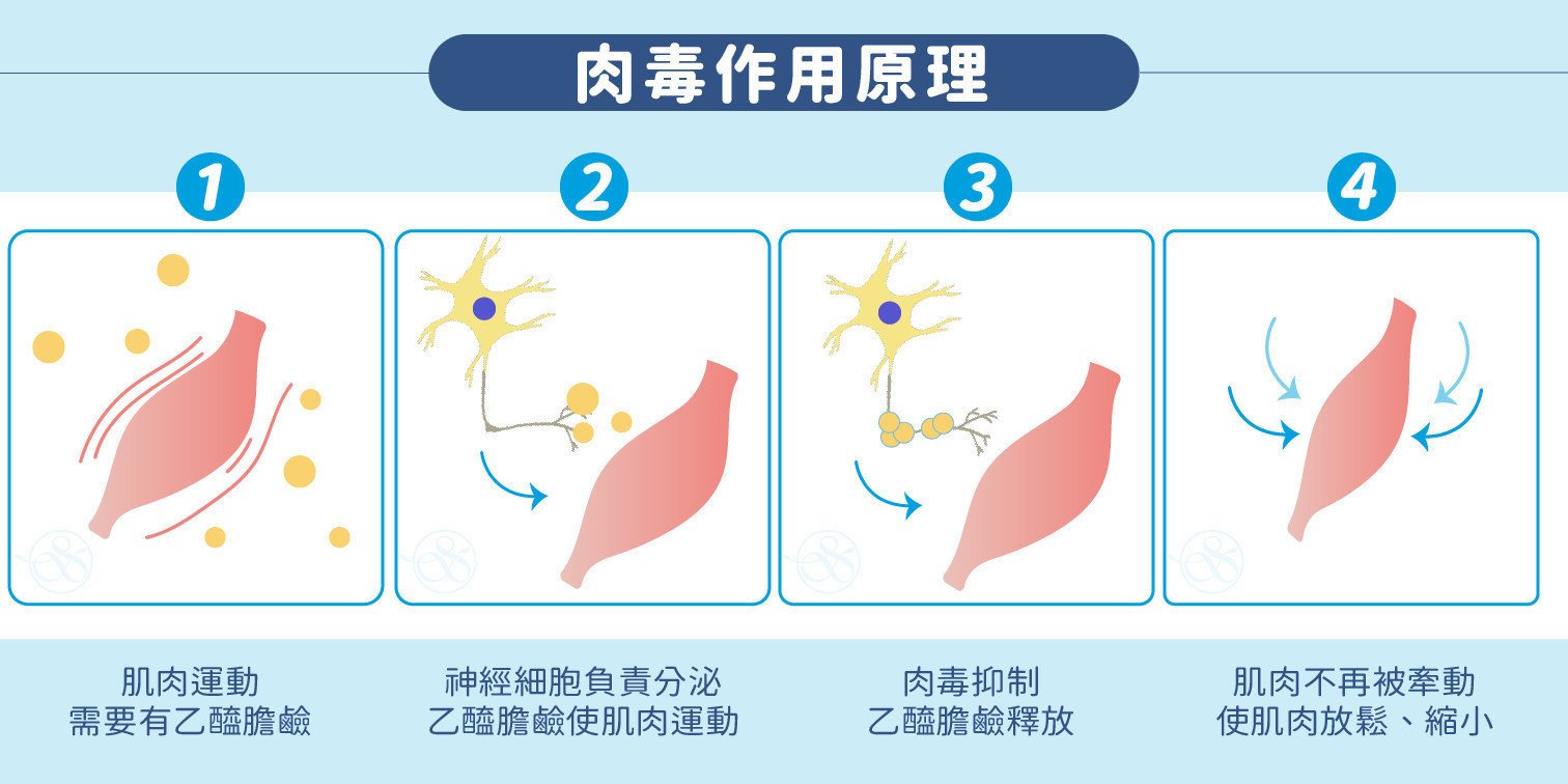 肉毒桿菌抑制乙酰膽鹼阻斷神經肌肉信號傳遞