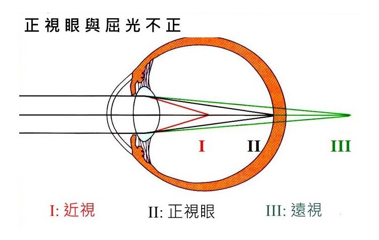 正視眼與屈光不正