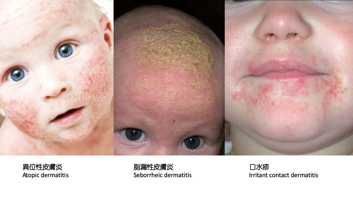 嬰兒脂溢性皮膚炎與其他濕疹對照:中間圖示為脂溢性皮膚炎引起的厚油皮屑與發紅症狀,是嬰兒期常見且會自癒的皮膚狀況。